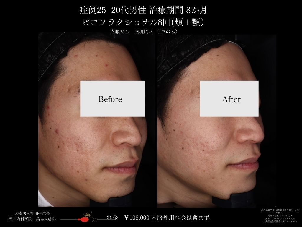 ピコレーザー症例_vol.25_002