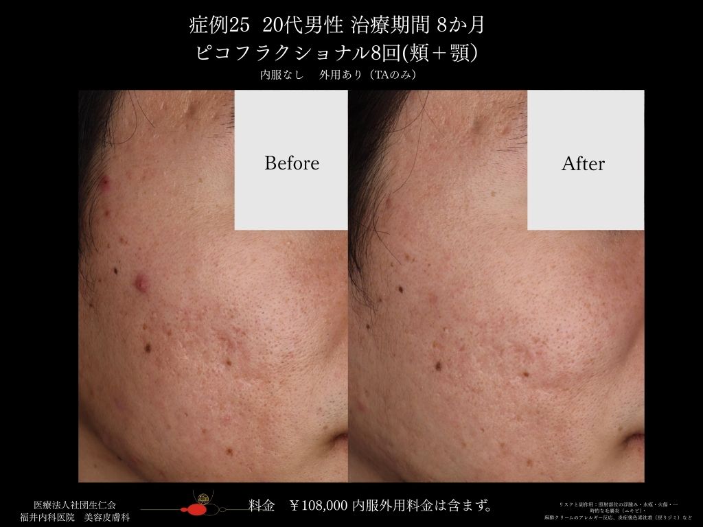 ピコレーザー症例_vol.25_003