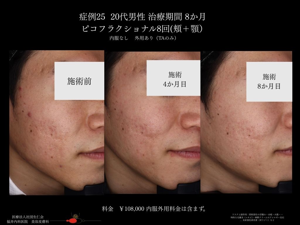 ピコレーザー症例_vol.25_004