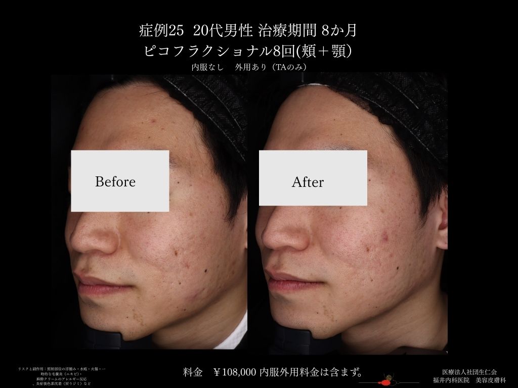 ピコレーザー症例_vol.25_005