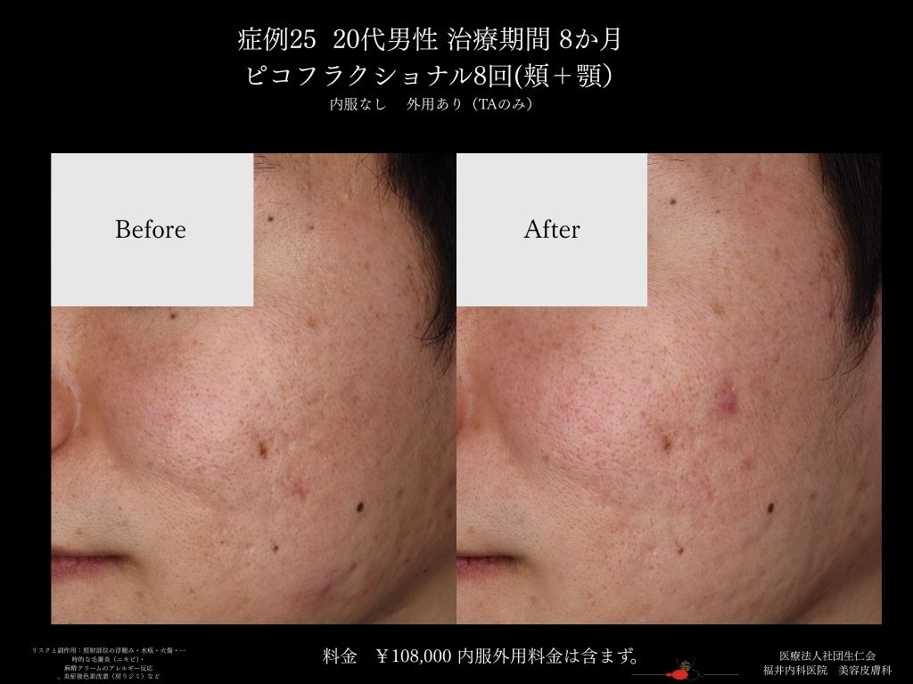 ピコレーザー症例_vol.25_006