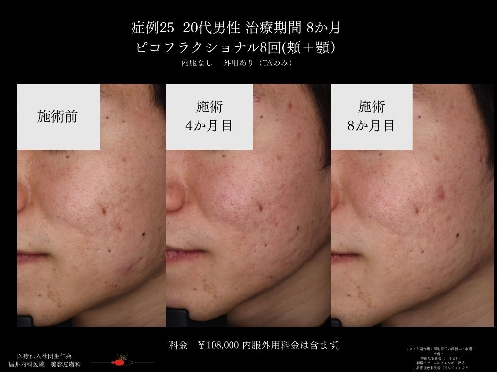 ピコレーザー症例_vol.25_007