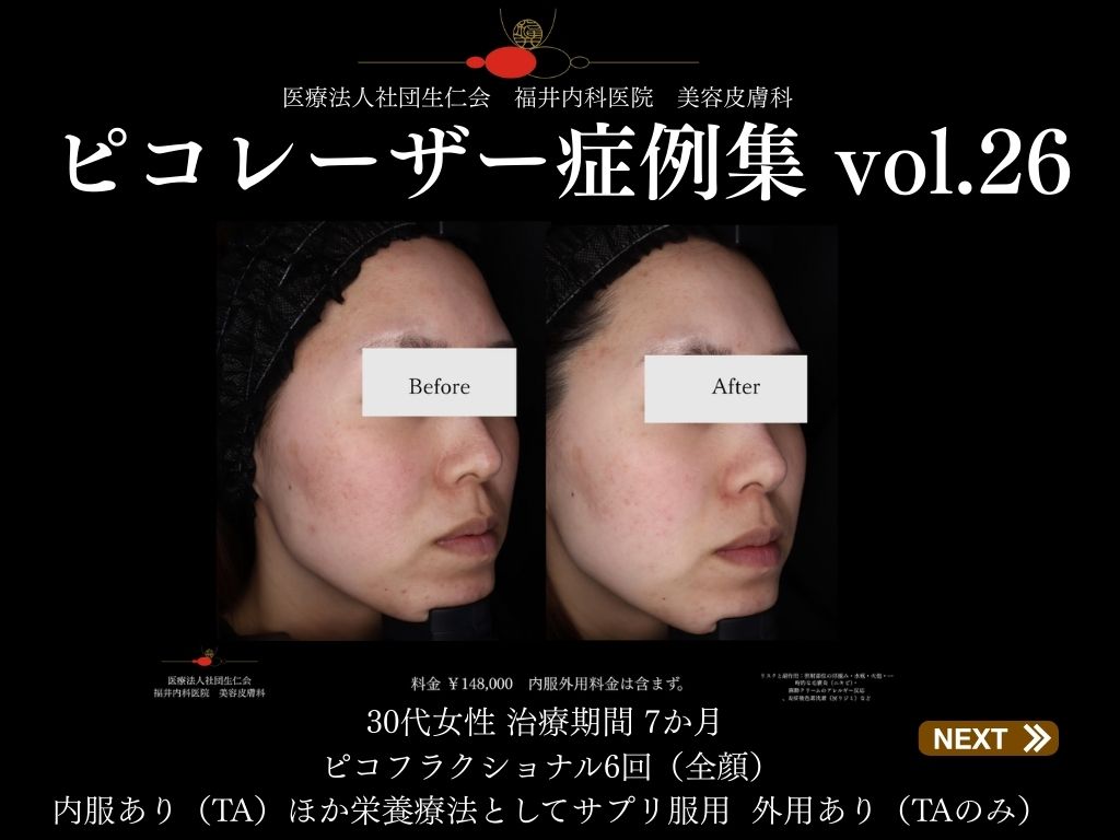 ピコレーザー症例_vol.26_001