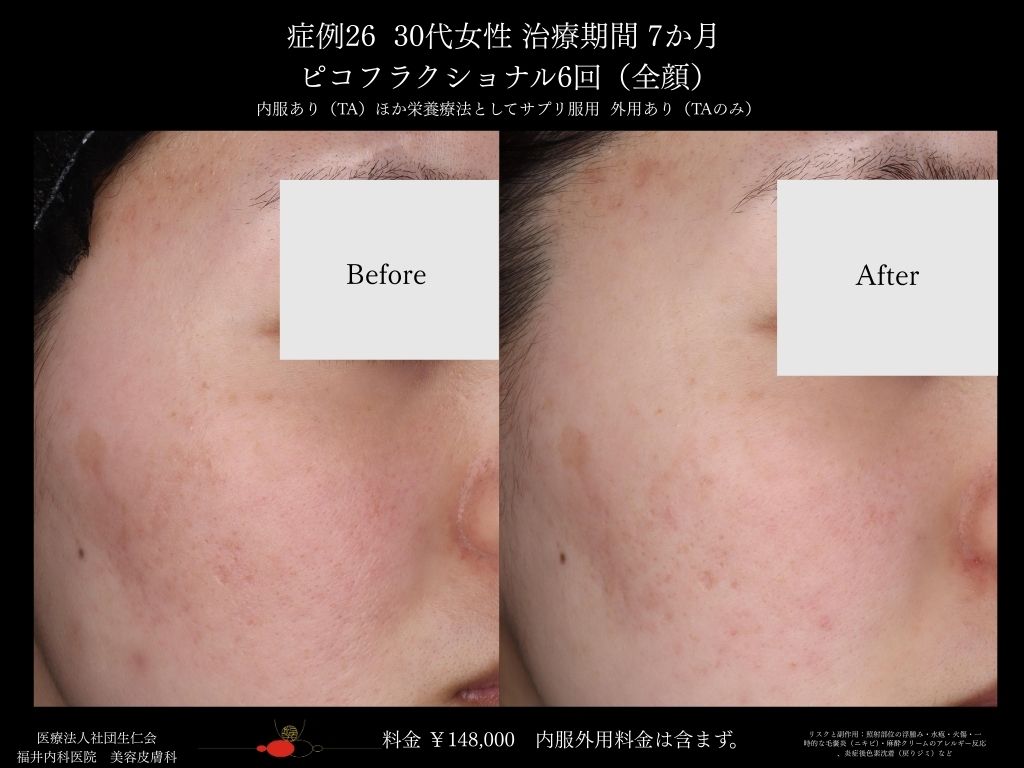 ピコレーザー症例_vol.26_002