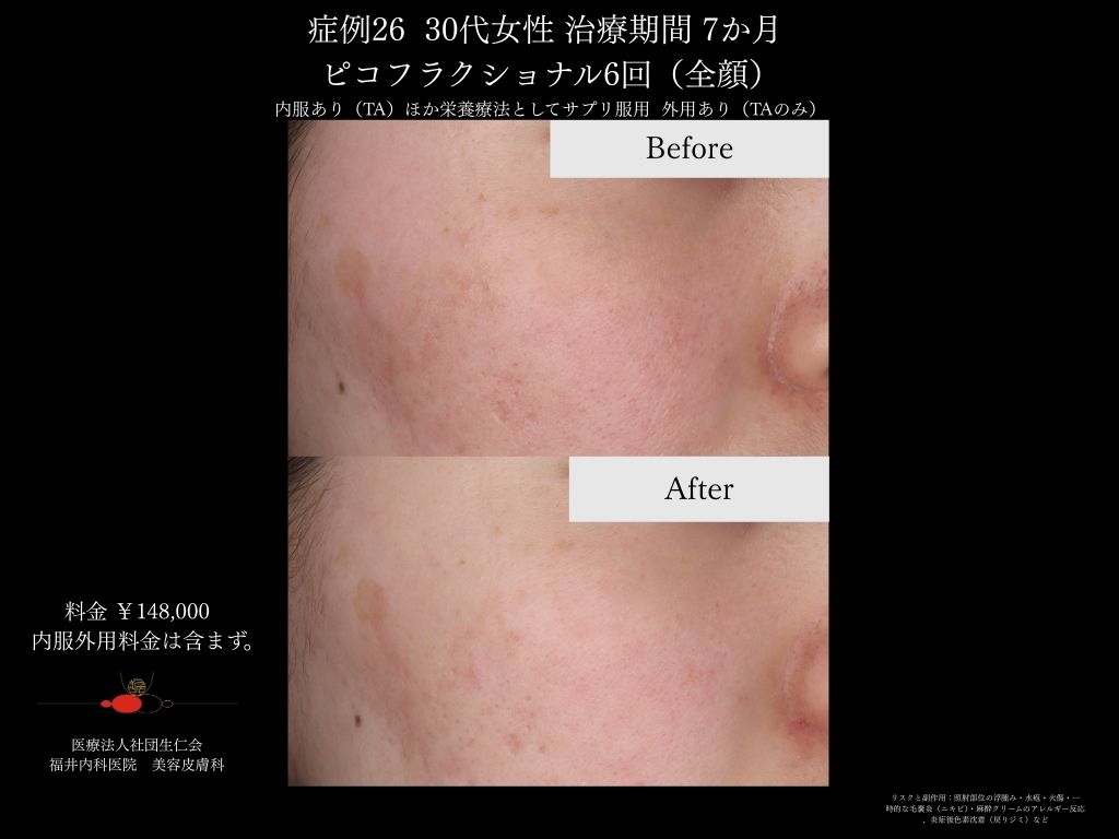 ピコレーザー症例_vol.26_003