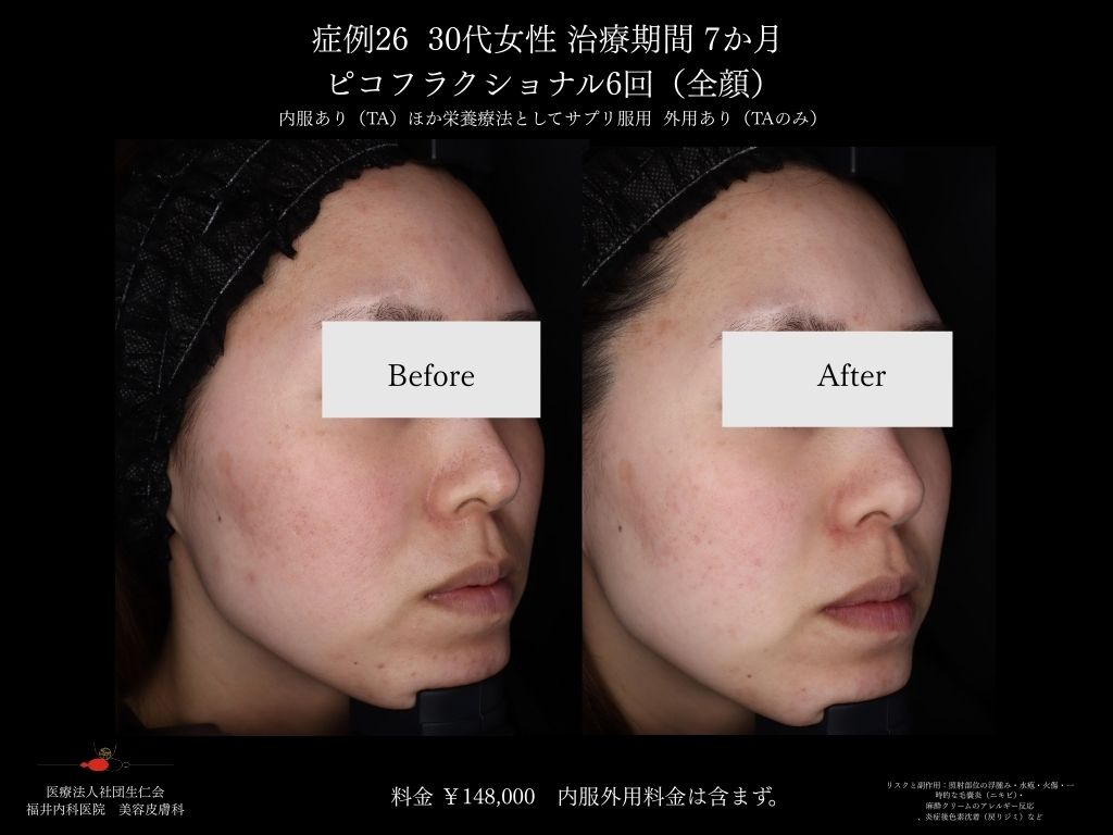 ピコレーザー症例_vol.26_004
