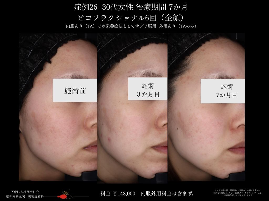 ピコレーザー症例_vol.26_005