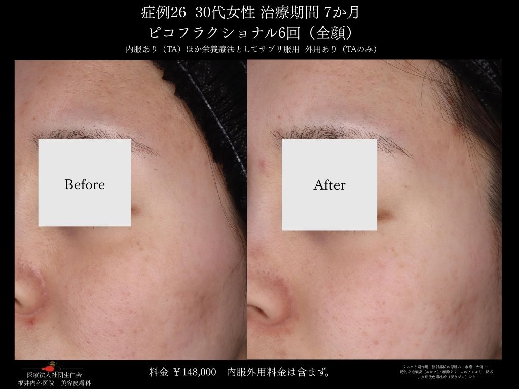 ピコレーザー症例_vol.26_006
