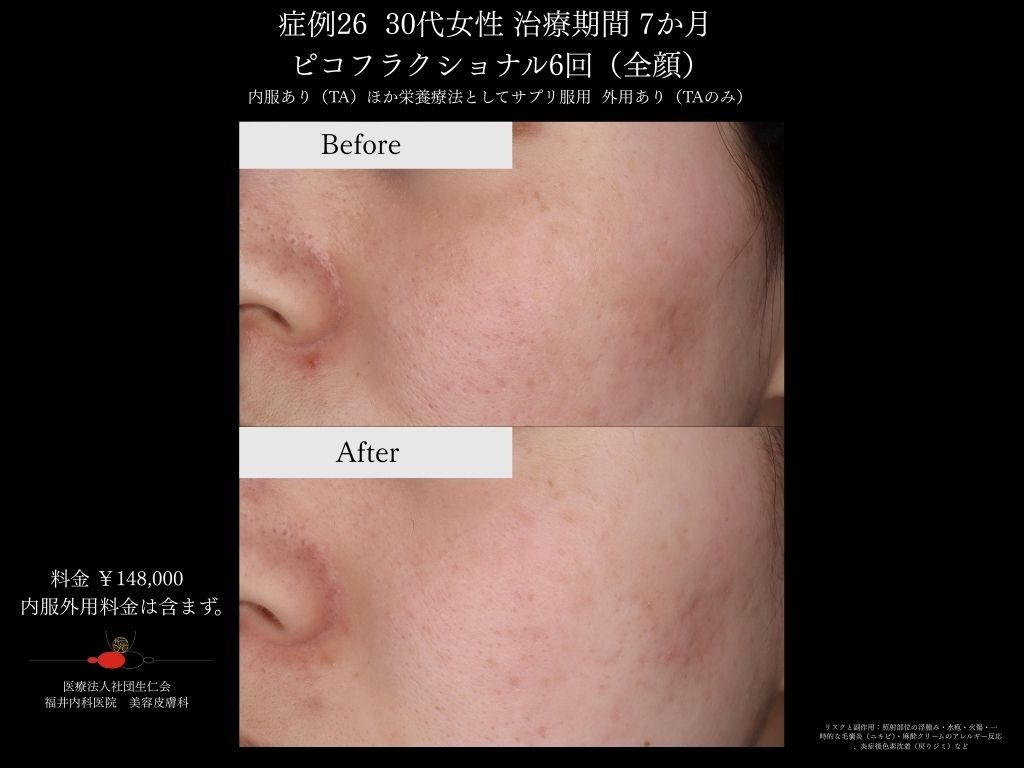 ピコレーザー症例_vol.26_007
