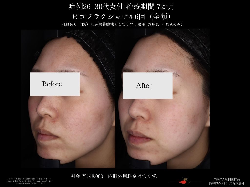 ピコレーザー症例_vol.26_008