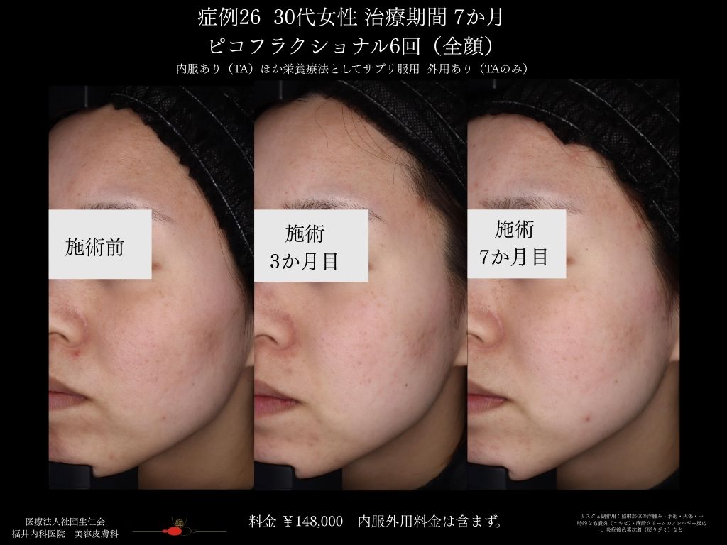 ピコレーザー症例_vol.26_009