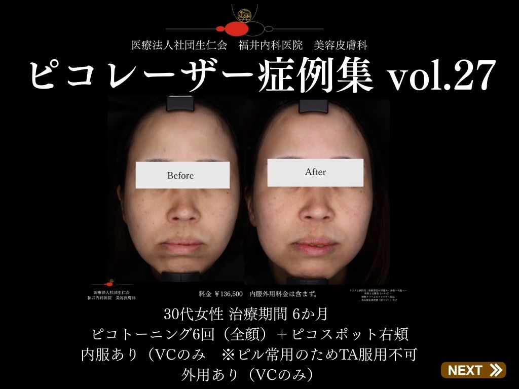 ピコレーザー症例_vol.27_001