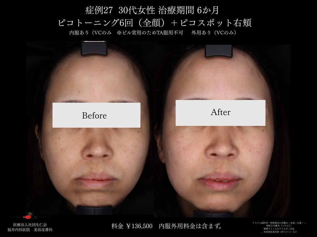 ピコレーザー症例_vol.27_002