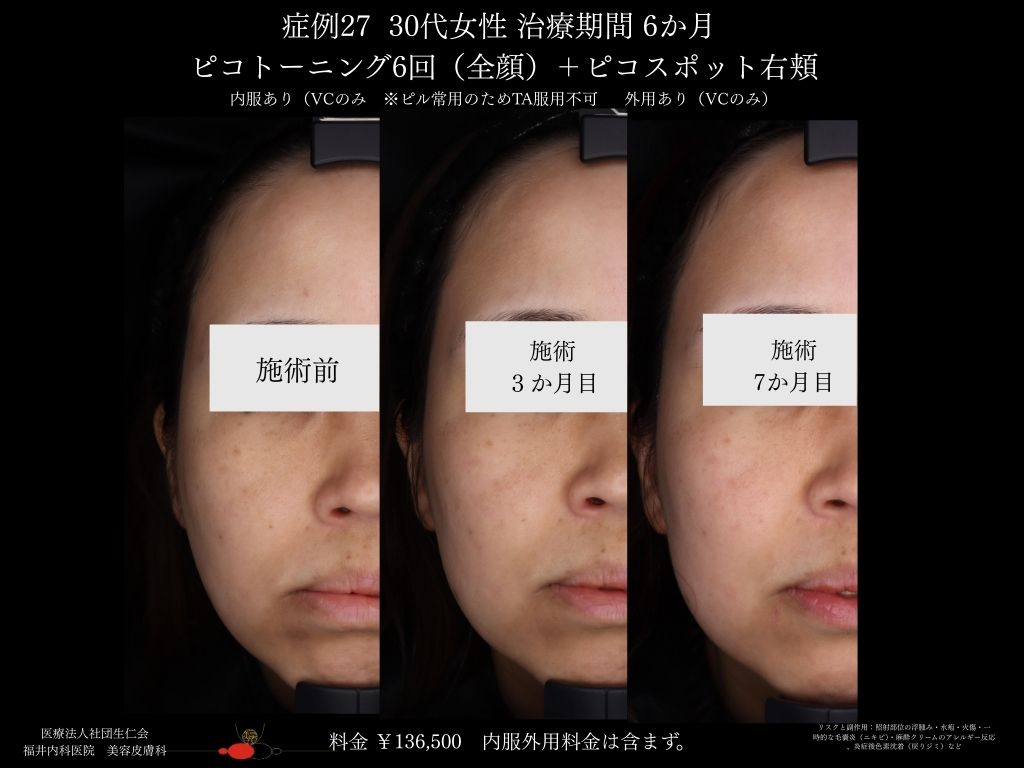 ピコレーザー症例_vol.27_003