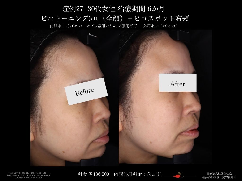 ピコレーザー症例_vol.27_004