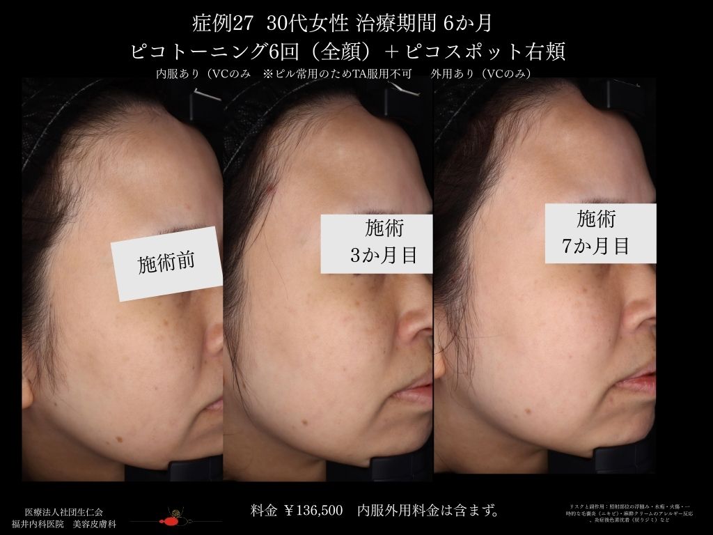 ピコレーザー症例_vol.27_005