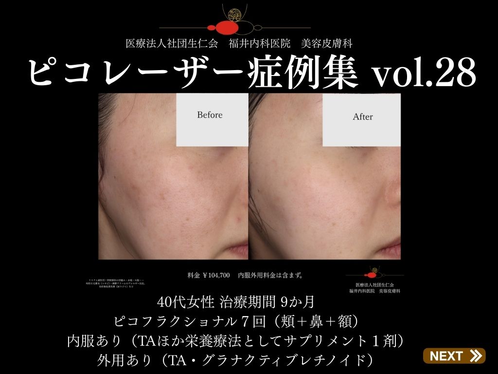 ピコレーザー症例_vol.28_001