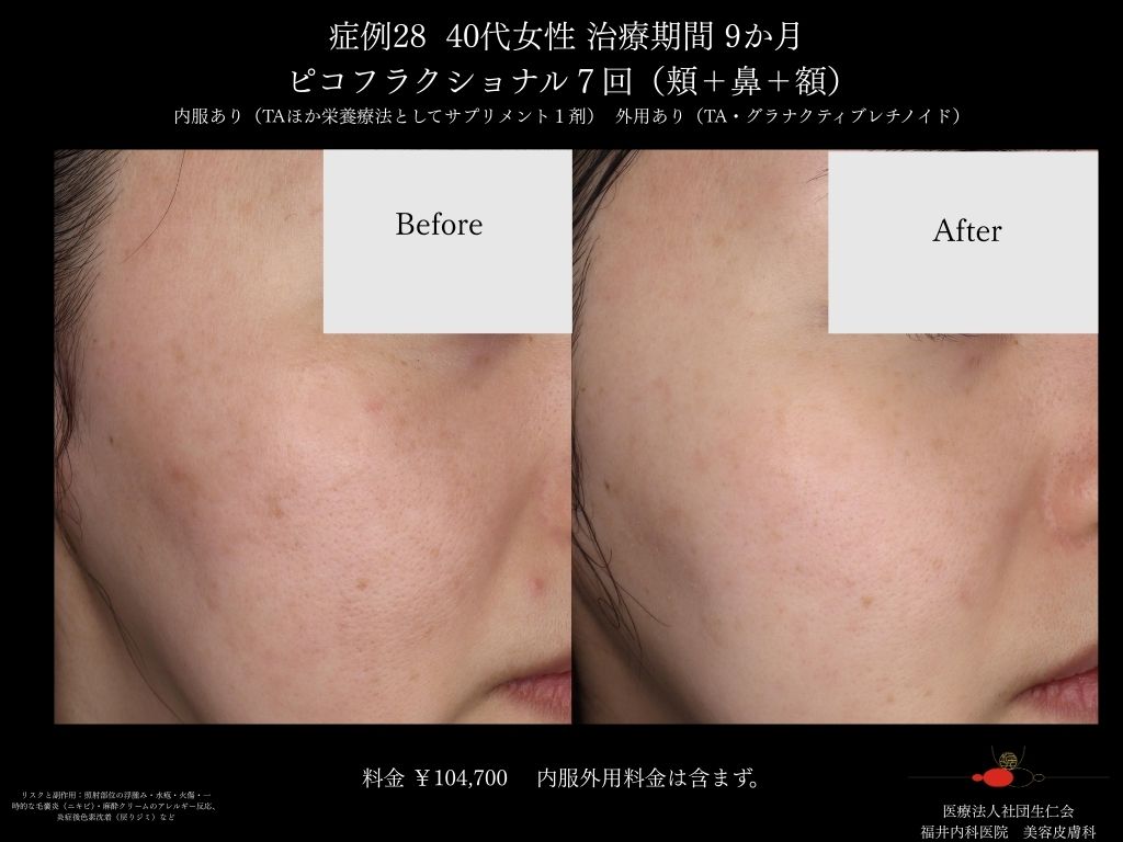 ピコレーザー症例_vol.28_002