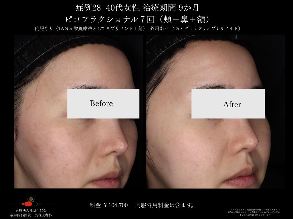 ピコレーザー症例_vol.28_003