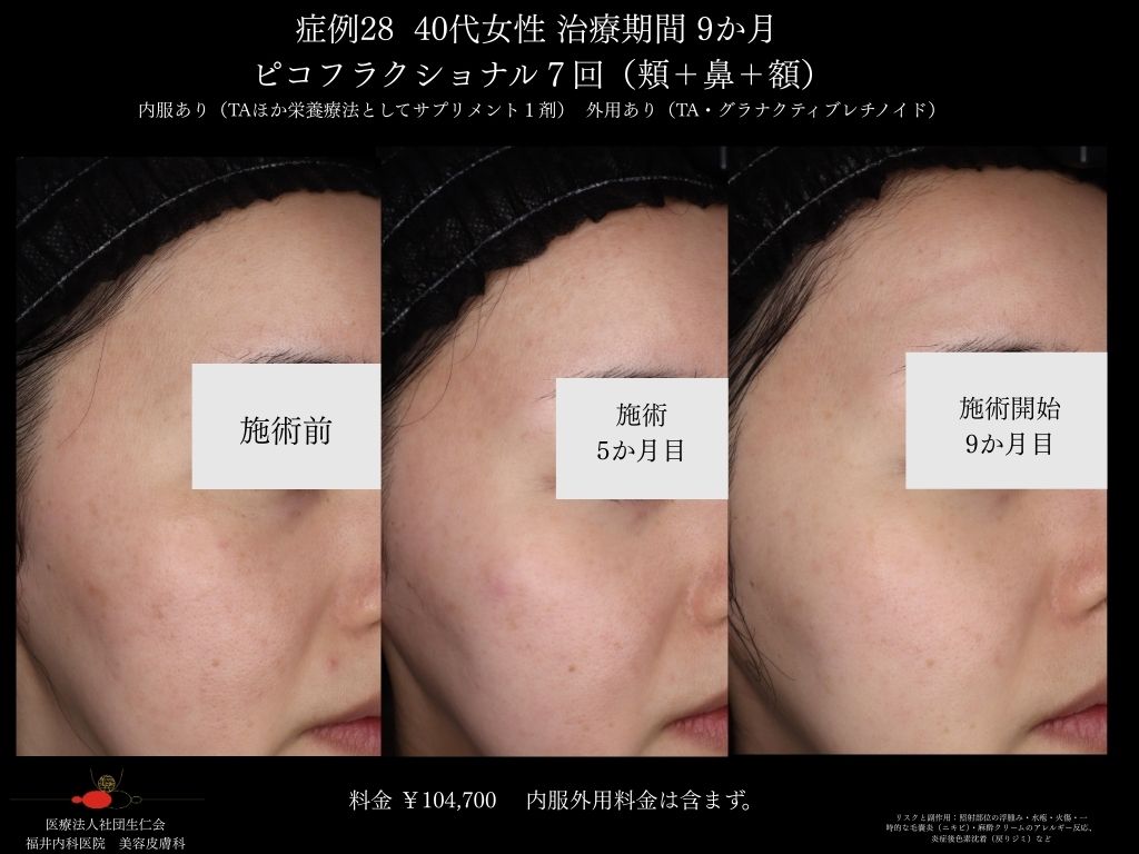 ピコレーザー症例_vol.28_004