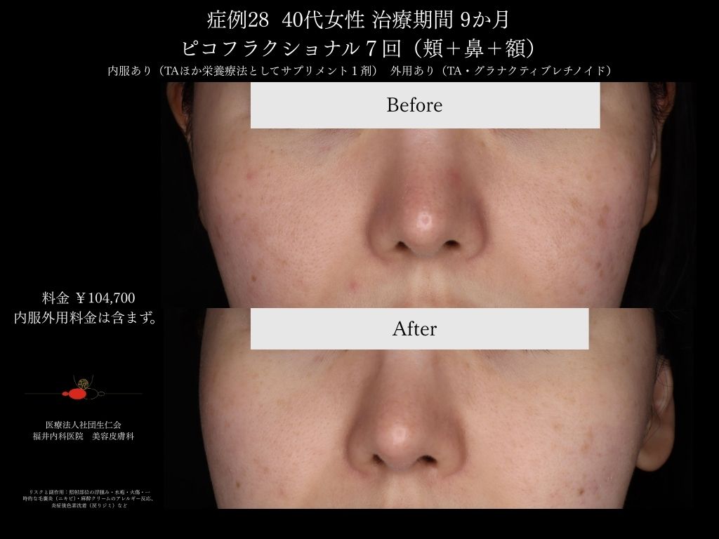 ピコレーザー症例_vol.28_005