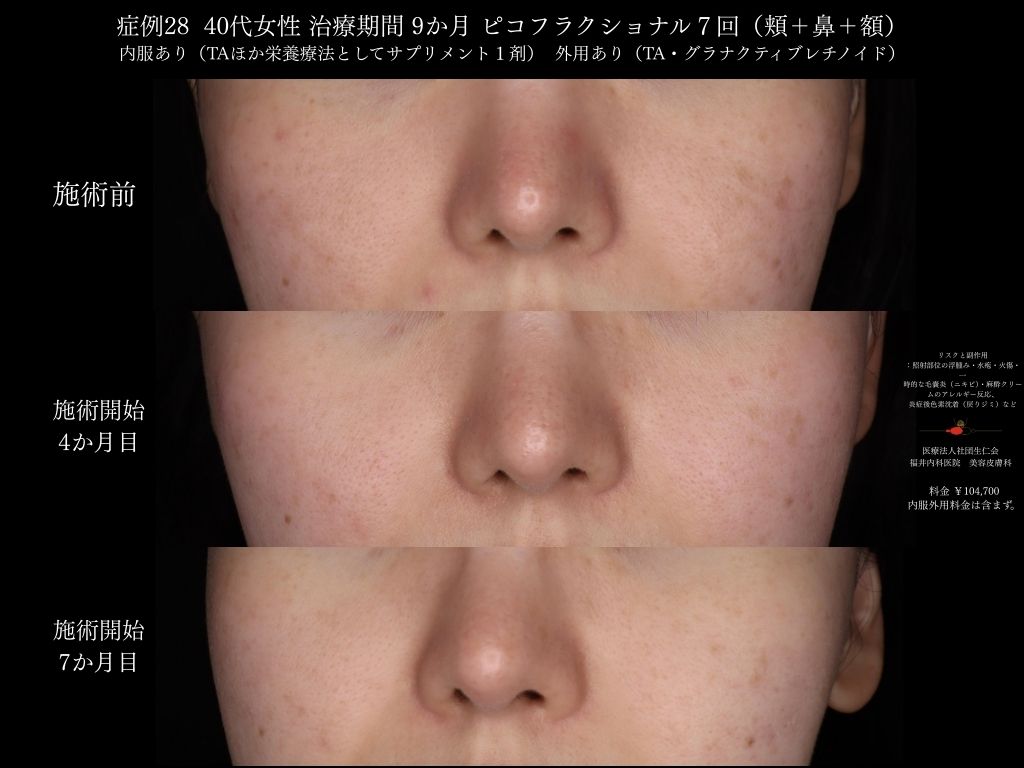 ピコレーザー症例_vol.28_006