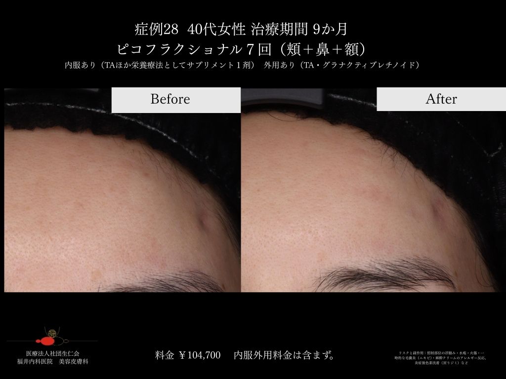 ピコレーザー症例_vol.28_007