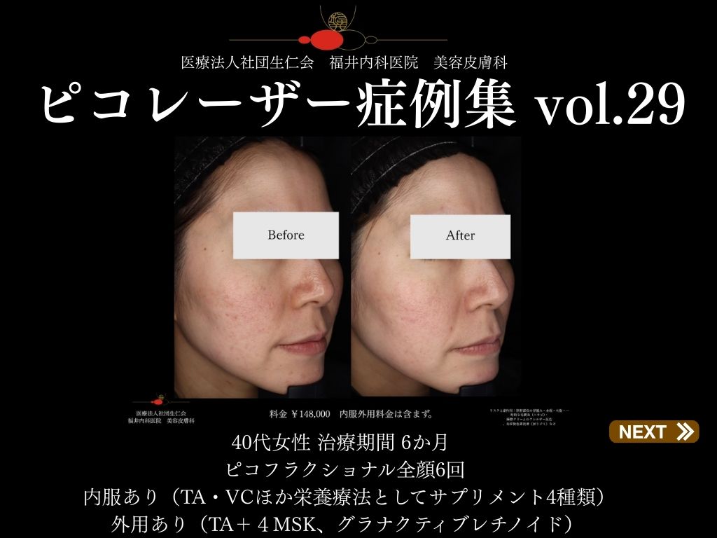 ピコレーザー症例_vol.29_001