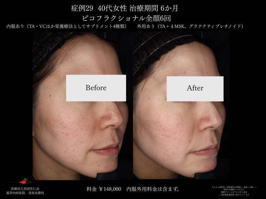 ピコレーザー症例_vol.29_002