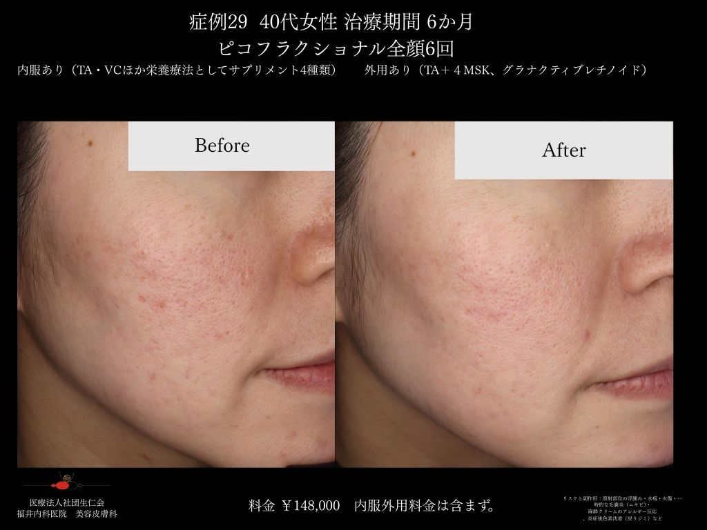 ピコレーザー症例_vol.29_003