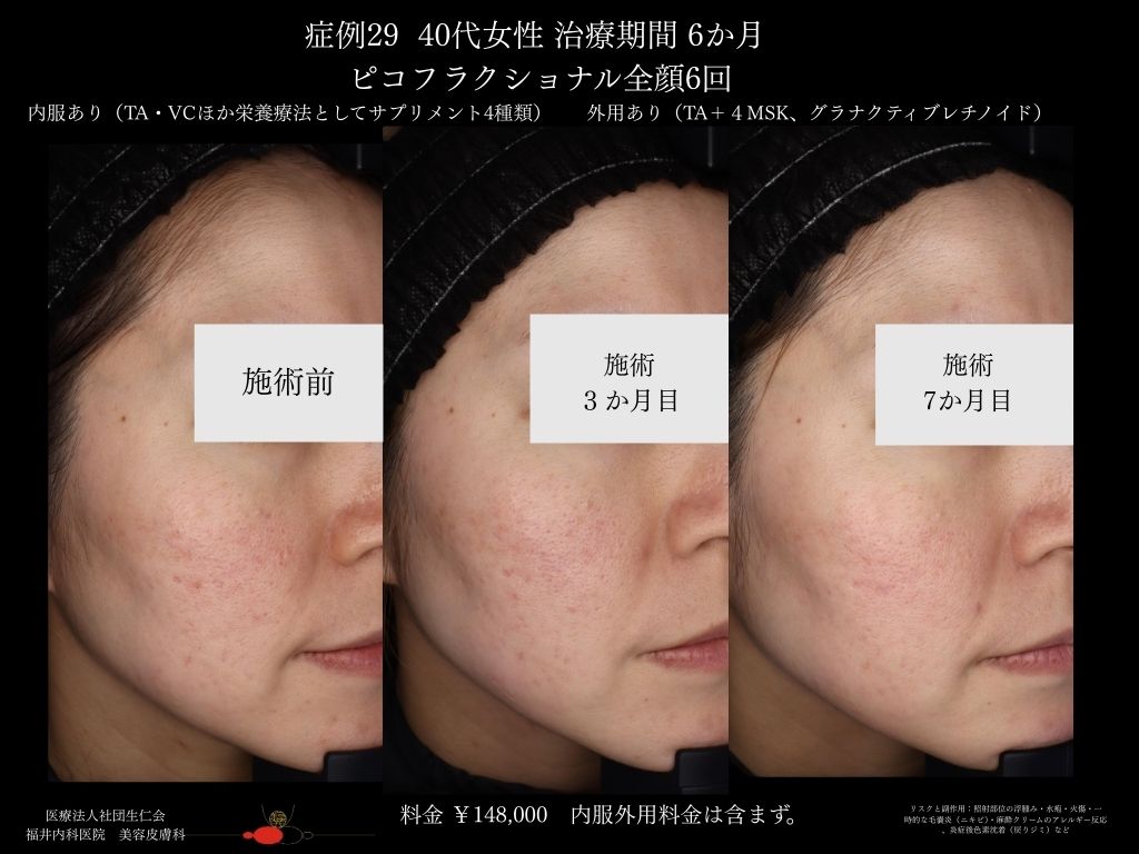 ピコレーザー症例_vol.29_004
