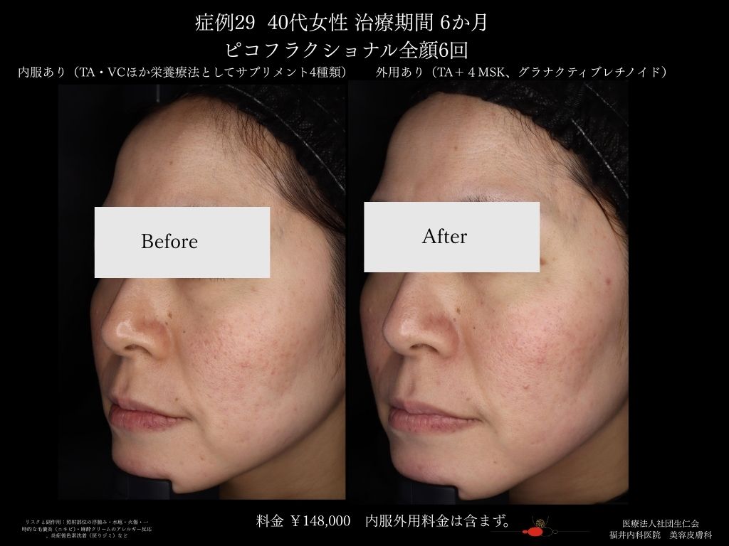 ピコレーザー症例_vol.29_005