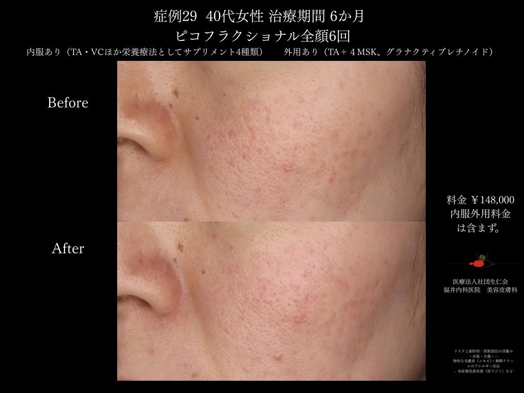ピコレーザー症例_vol.29_006