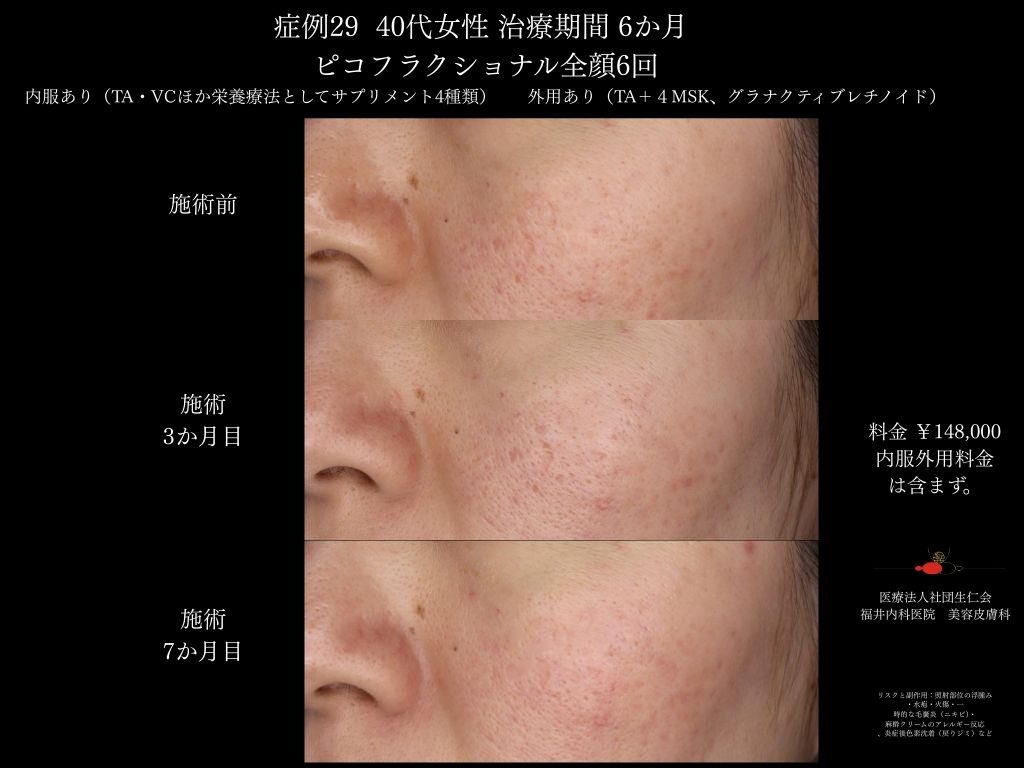 ピコレーザー症例_vol.29_007