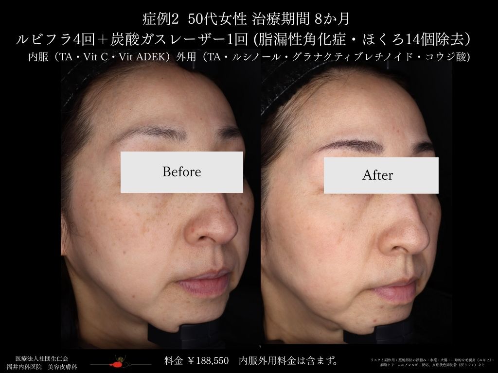 ピコレーザー症例_vol.2_002