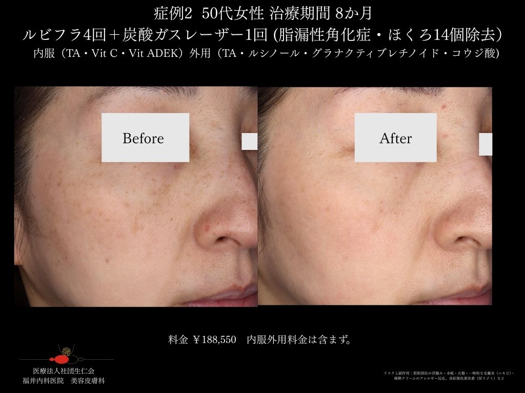 ピコレーザー症例_vol.2_003