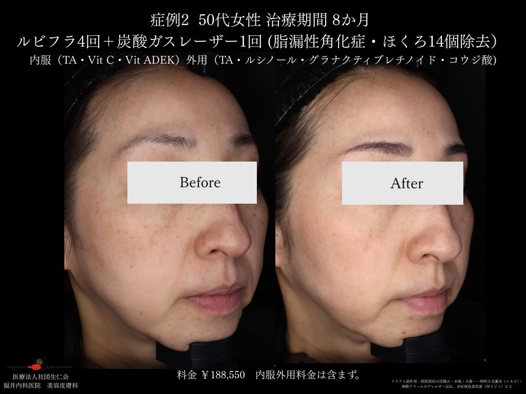 ピコレーザー症例_vol.2_004