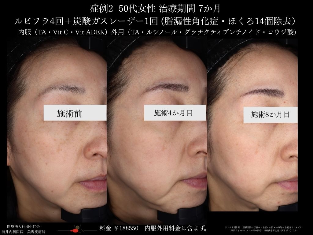 ピコレーザー症例_vol.2_005