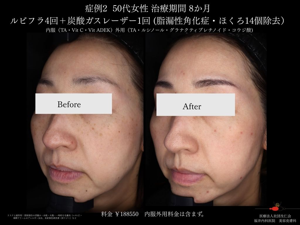 ピコレーザー症例_vol.2_006