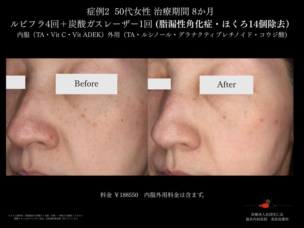 ピコレーザー症例_vol.2_007