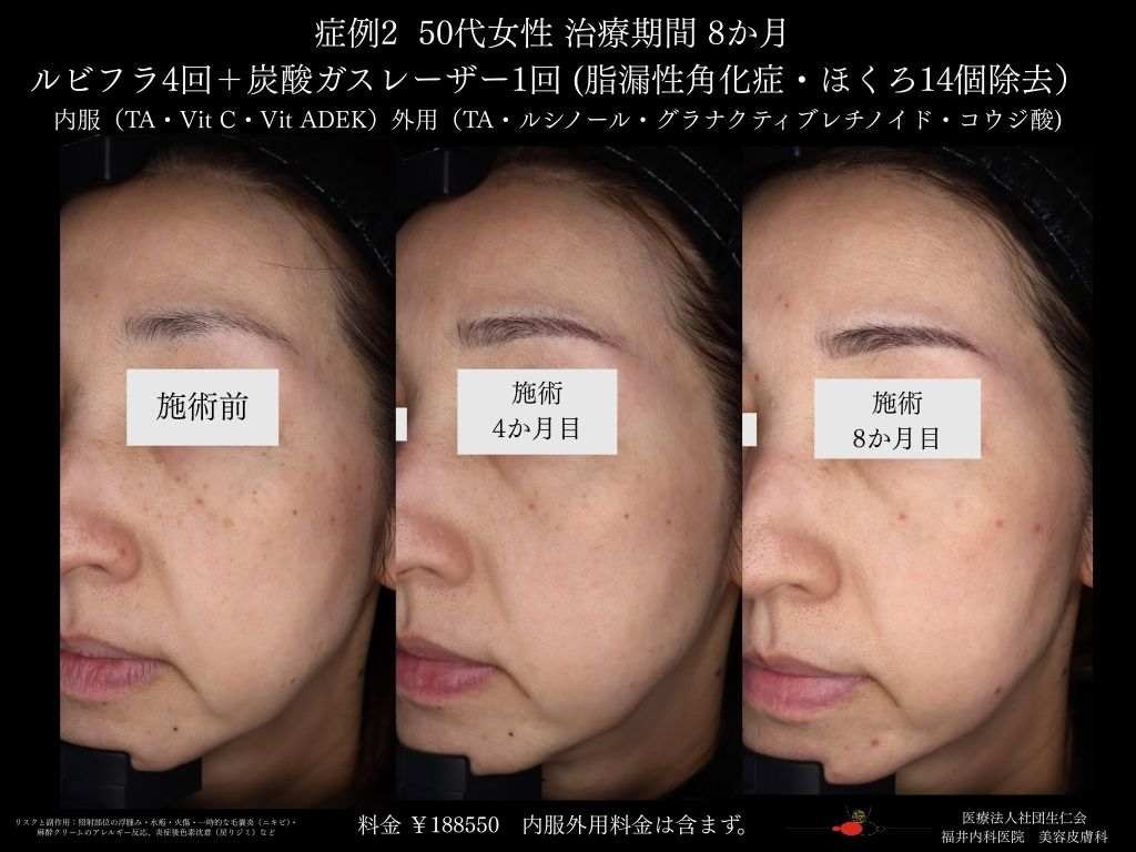 ピコレーザー症例_vol.2_008