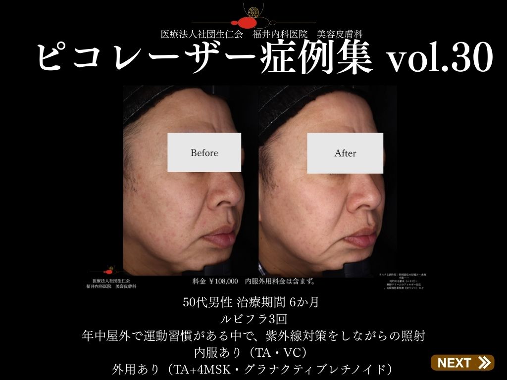 ピコレーザー症例_vol.30_001