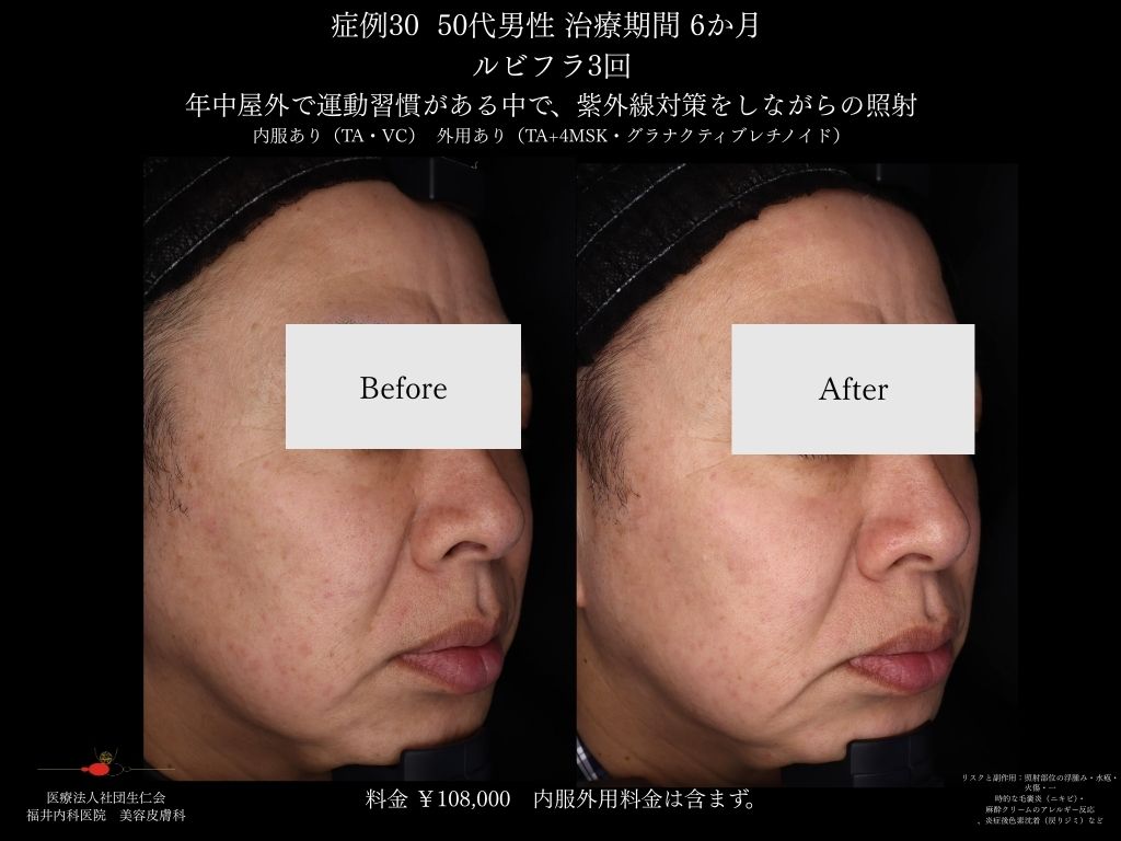 ピコレーザー症例_vol.30_002