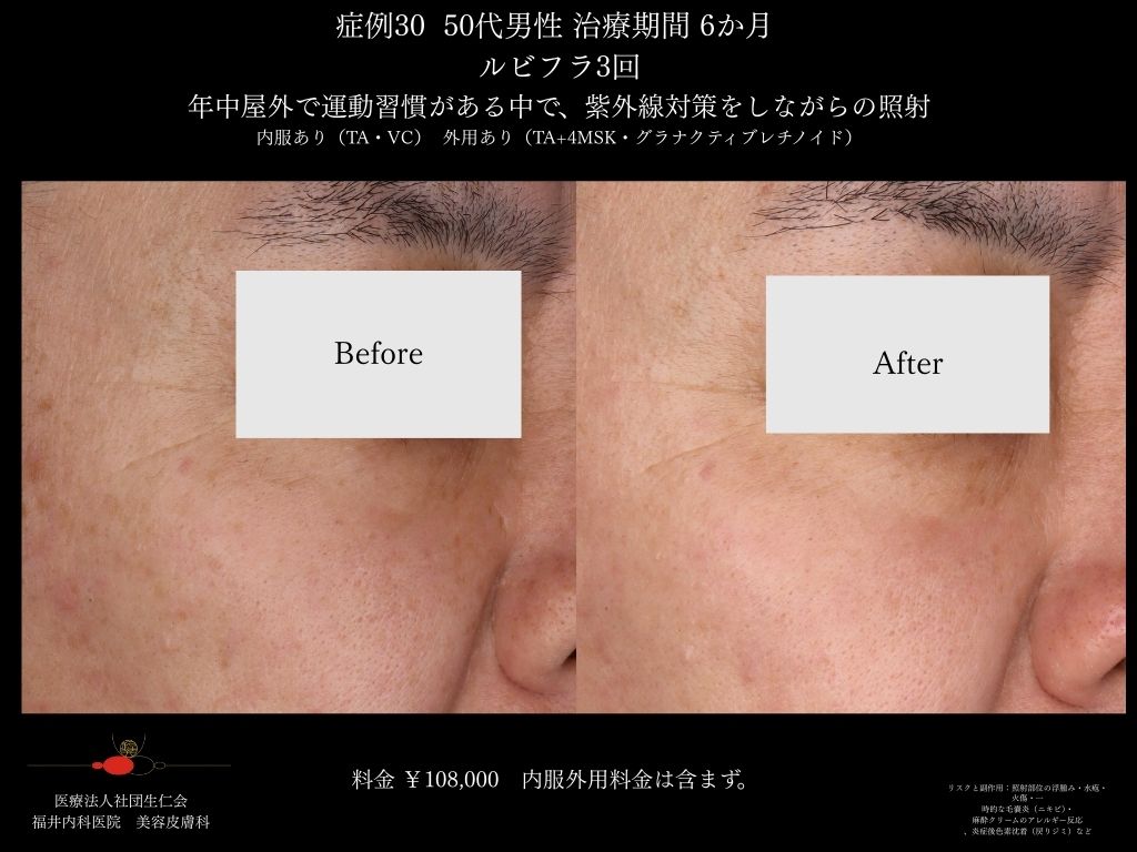 ピコレーザー症例_vol.30_003