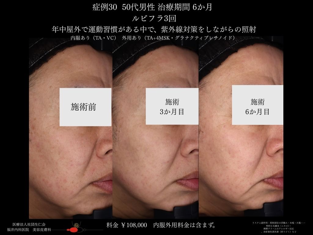 ピコレーザー症例_vol.30_004