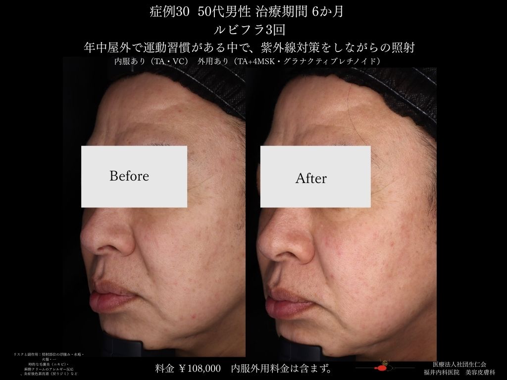 ピコレーザー症例_vol.30_005