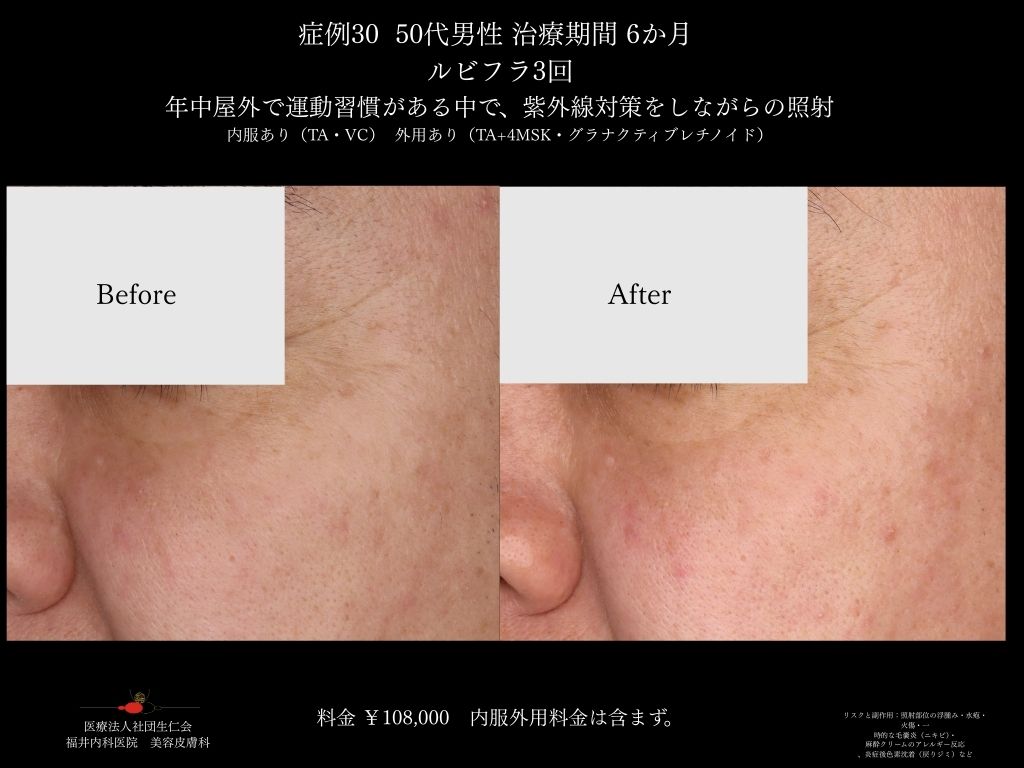 ピコレーザー症例_vol.30_006