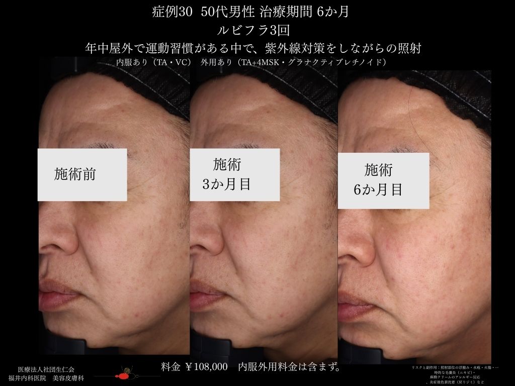 ピコレーザー症例_vol.30_007