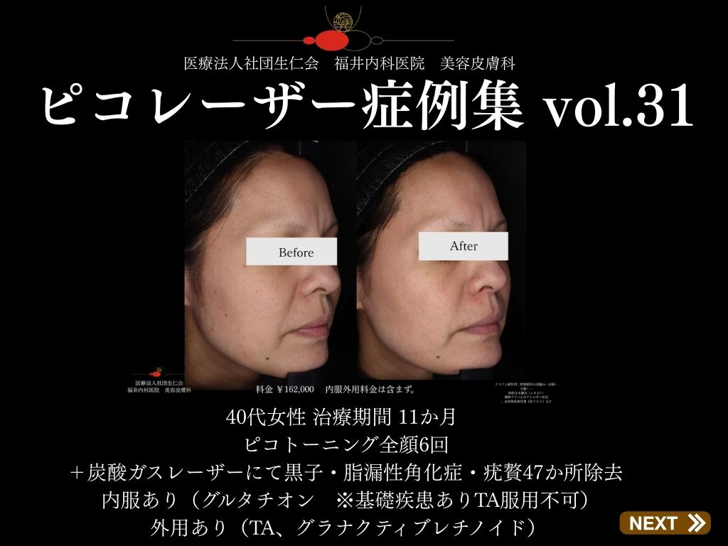 ピコレーザー症例_vol.31_001