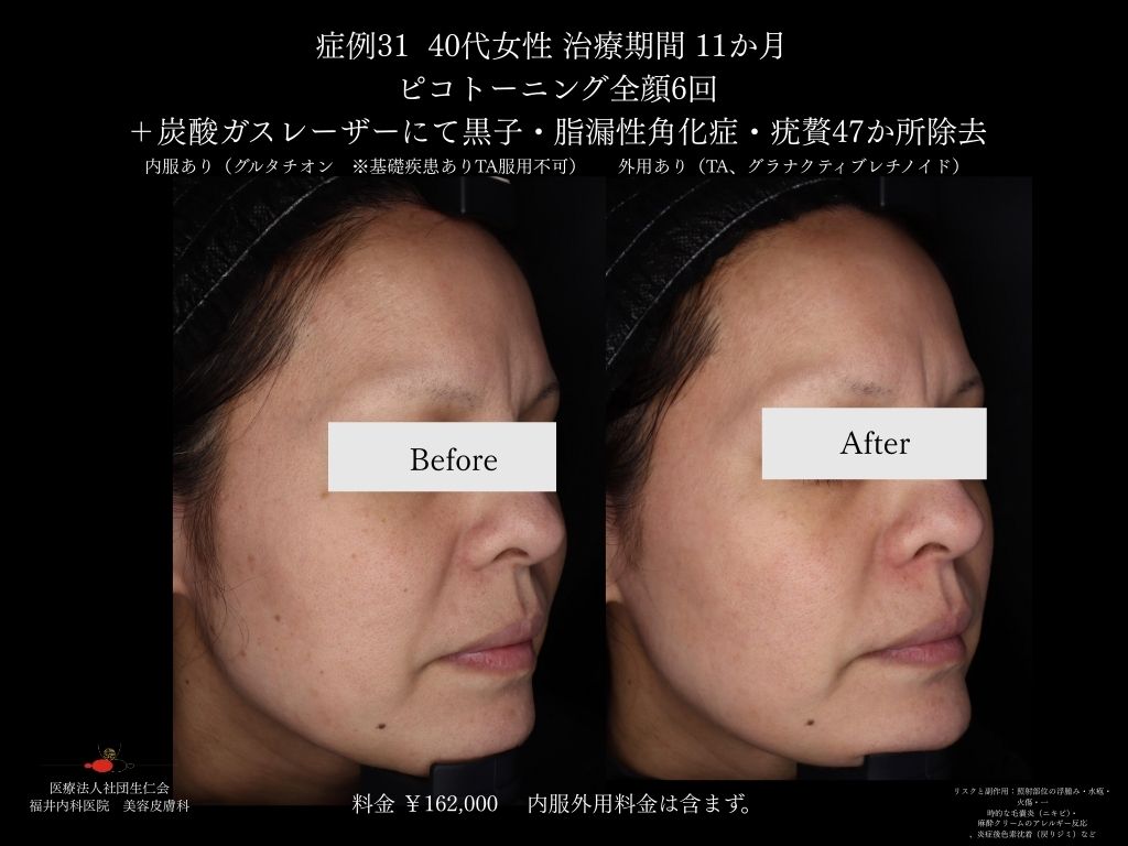 ピコレーザー症例_vol.31_002